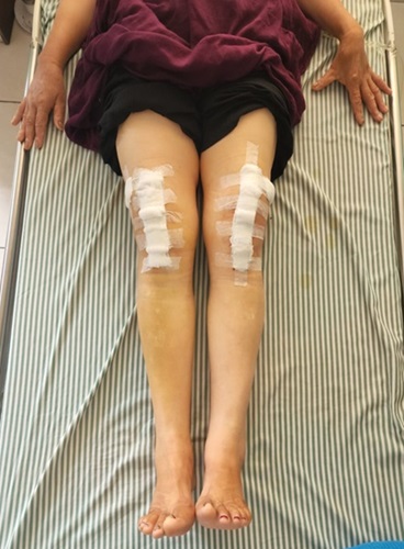 Robotic total Knee Replacement in Mandi HP